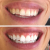 Diamond Smile Ergebnis Vorher Nachher Zahnbleaching Streifen zur Zahnaufhellung für zu Hause