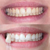 Vorher Nachher Zahnbleaching von Bleaching Glow Stick von Diamond Smile
